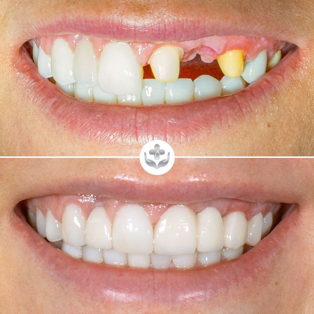 Blanqueamiento dental antes y después, Philips Zoom en una sola visita, Medellín, Colombia
