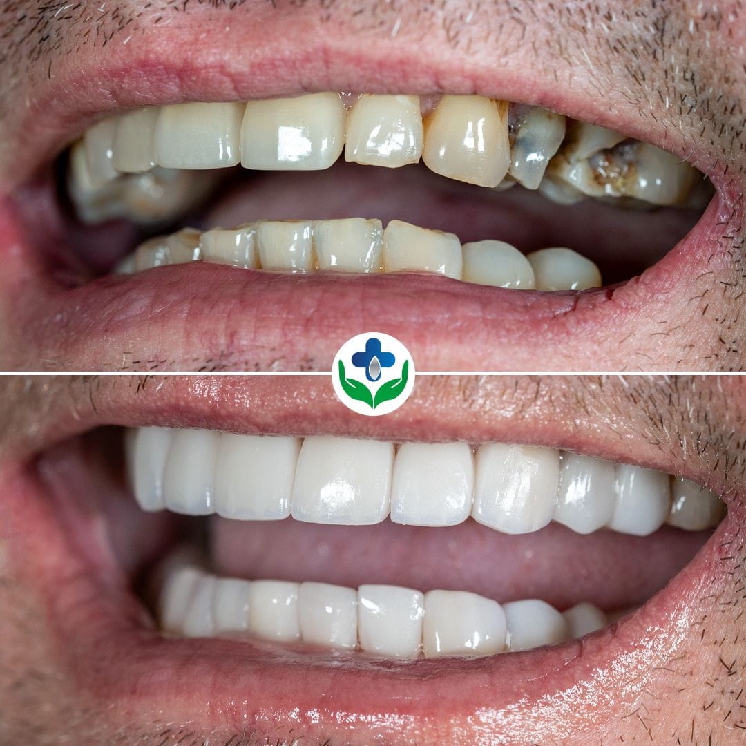 Corona dental antes y después, corrección de decoloración, Medellín, Colombia