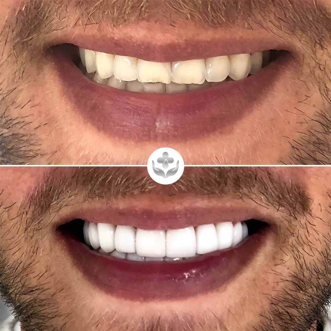 Composite veneers before and after — short teeth lengthened, Medellín, Colombia