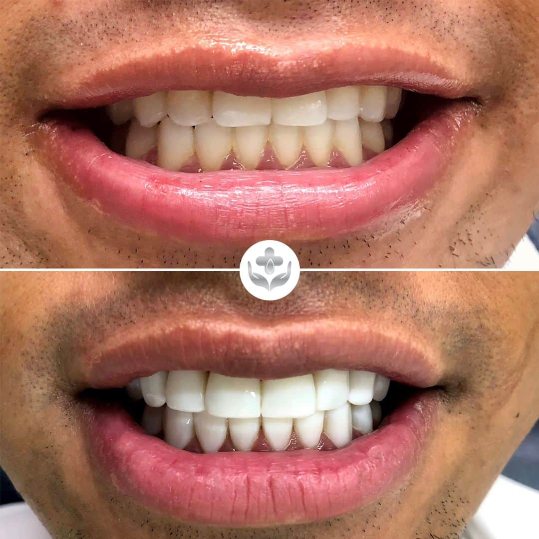 Composite veneers before and after — chipped front teeth restored, Medellín, Colombia