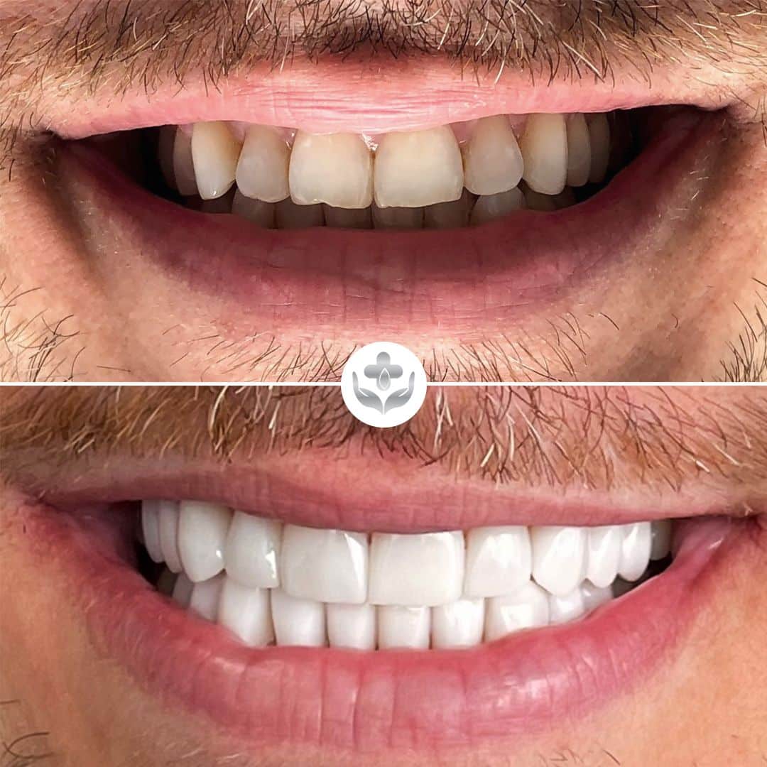 Corona dental antes y después, restauración de diente anterior, Medellín, Colombia