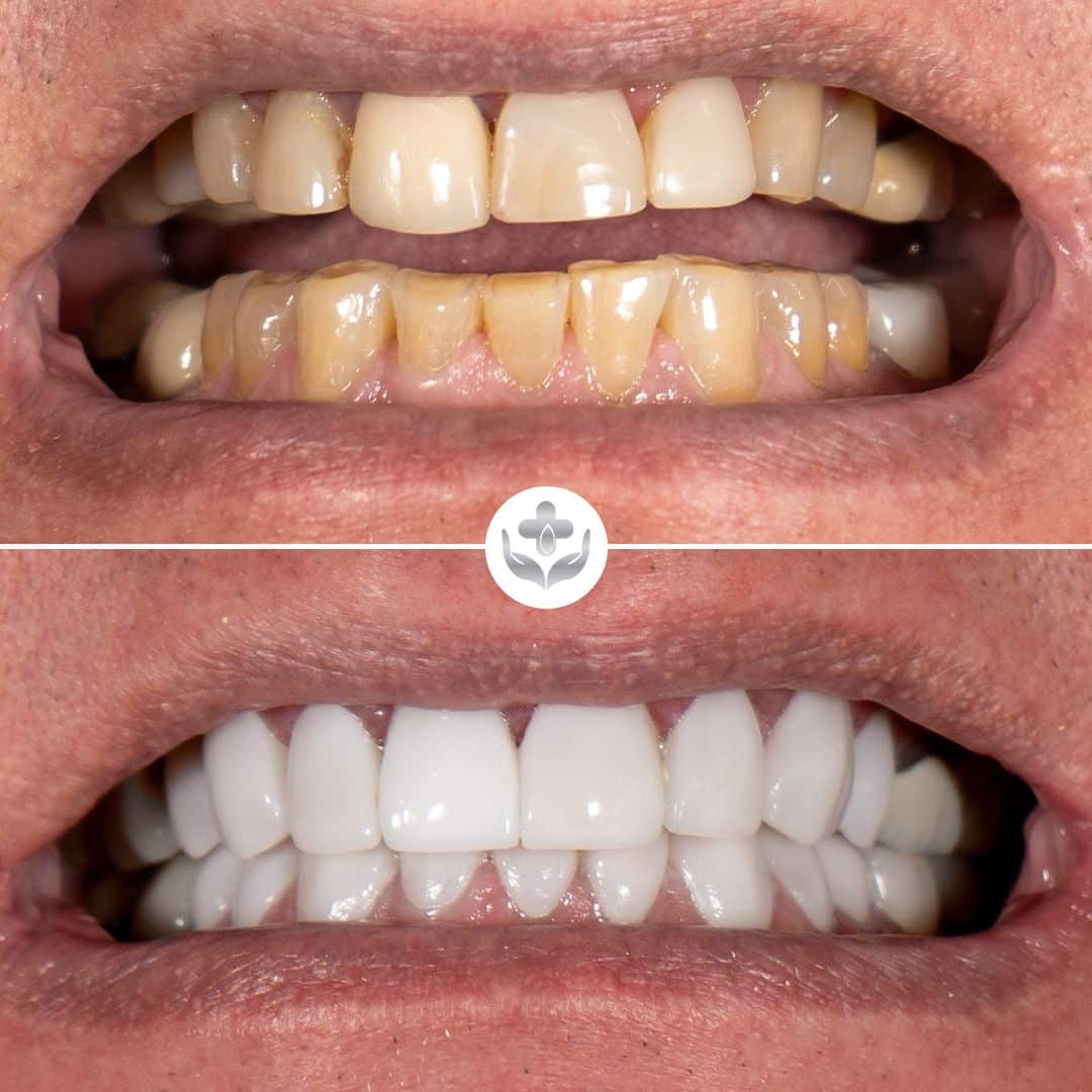 Diseño de sonrisa en zirconio antes y después, arcada completa, Medellín, Colombia