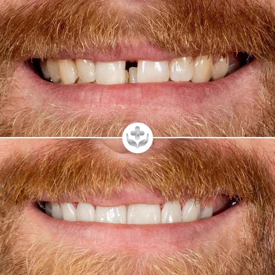 Carillas de zirconio antes y después, rediseño con mordida fuerte, Medellín, Colombia