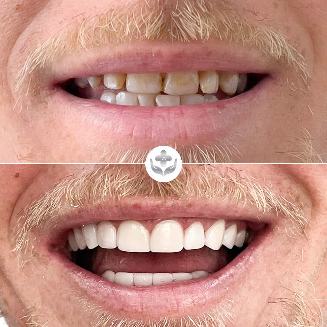Composite veneers before and after — gap closure, Medellín, Colombia