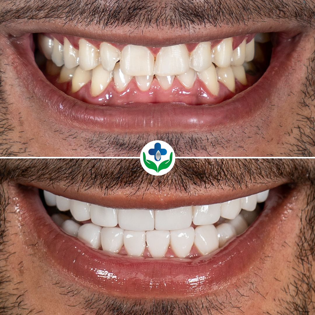 Composite veneers before and after — Anthony, Colombia Care Dental, Medellín