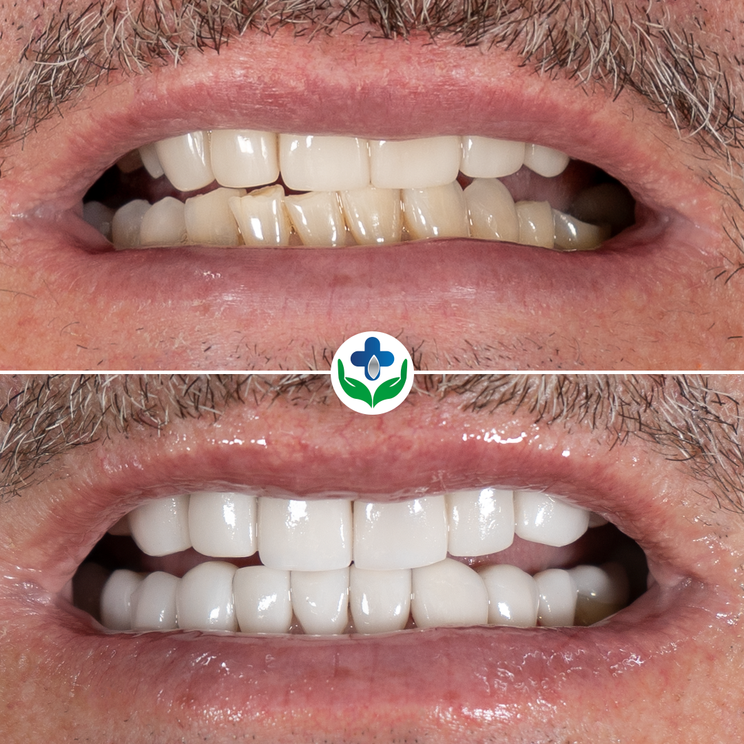Corona dental antes y después, restauración de boca completa, Medellín, Colombia