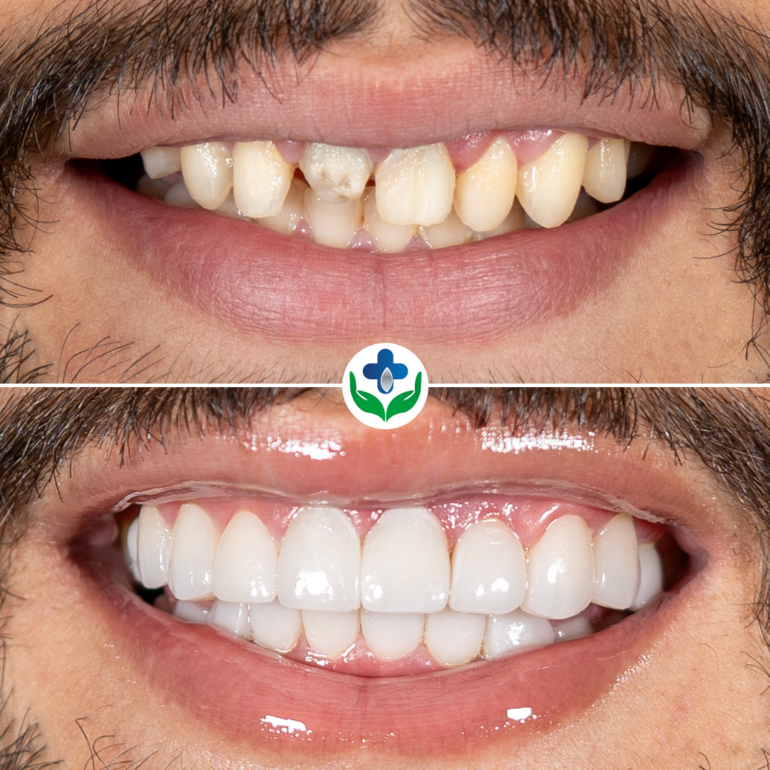 Antes y después de transformación de sonrisa, Gabriel, Colombia Care Dental, Medellín