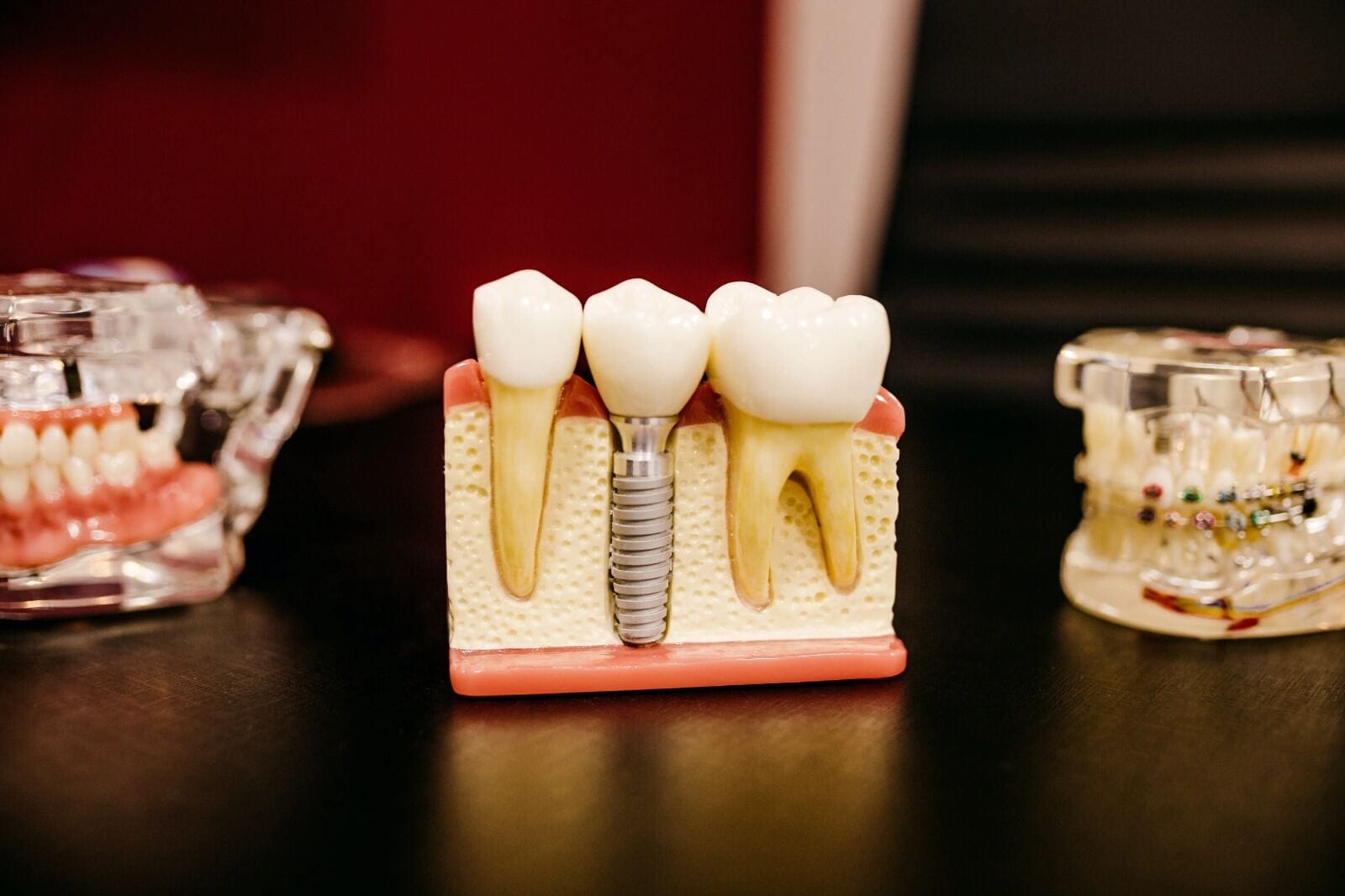 Implante de titanio BioHorizons con corona de zirconio ZirCAD Prime