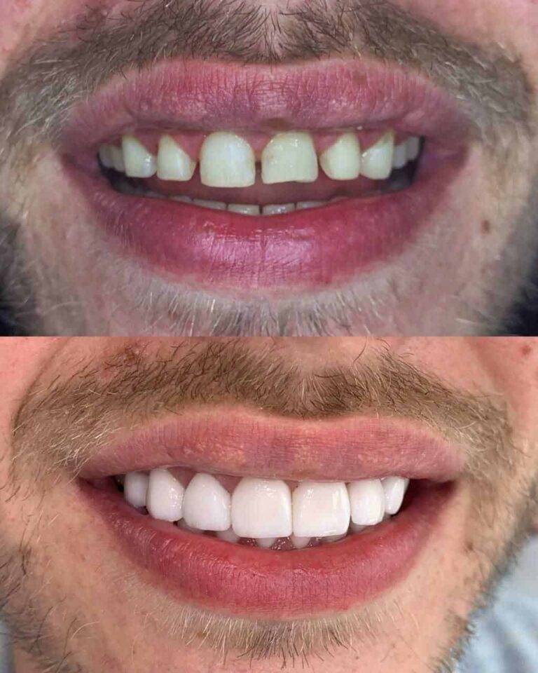 Customer Review for Porcelain Veneer in Medellin, Colombia Colombia