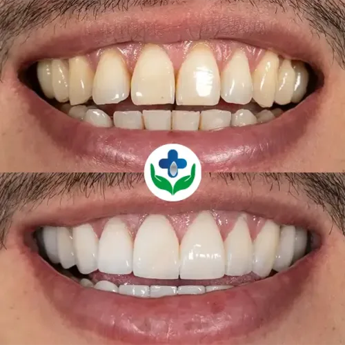 Img-ColombiaCare-Before_After-Whitening-1