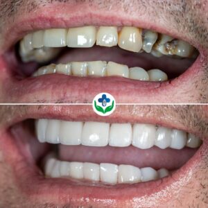 Veneers Colombia